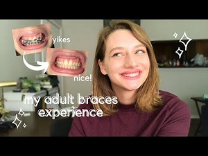 My Adult Braces Experience // deep overbite, bite plate, crowding, rubber bands