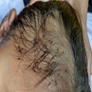 2.2K views | Getting out all hundred lice from hair | Purple Speedy Fan | Facebook