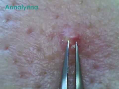 Luma 1 Ti Visual Blackhead Remover with Camera - Titanium Alloy Tweezers and HD Camera 20x Magnification, 1080P, 8 LED Lights, Blackhead Extractor for Men and Women, Acne and Pore Cleaner