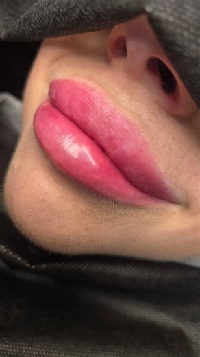 ✨ The Beauty of Subtle Lip Enhancement ✨ Lip filler doesn’t have to...