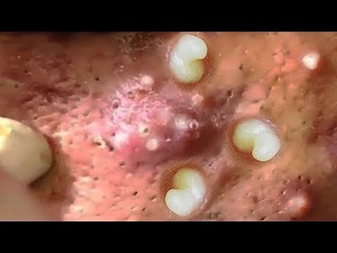 How to Removal Blackheads,Whiteheads #71