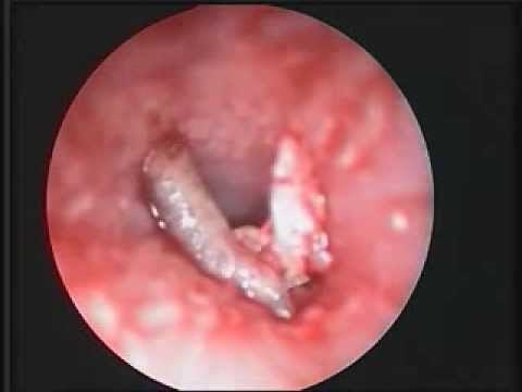 Fruit-fly Larva in the Auditory Canal | NEJM