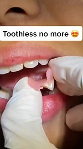 Don’t Spend Thousands on Tooth Replacement – Discover Affordable, High-Quality Solutions for Single or Full Mouth Procedures Near You! | Health Insights