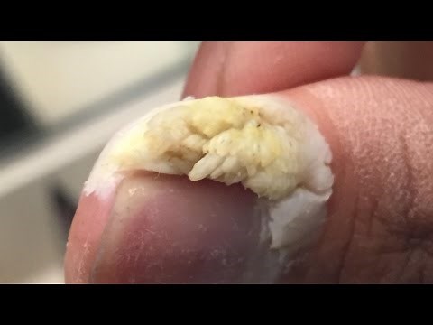 What Is It? Cyst, Wart, Ingrown Hair, Infected Boil?
