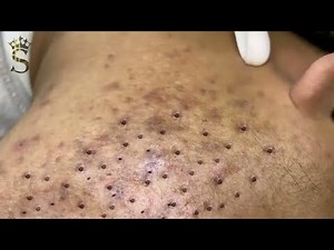 2025 Blackhead Removal: The Most Satisfying Extraction Ever! 4k