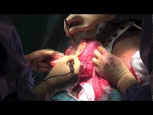 Réduction mammaire - Breast Reduction Surgery