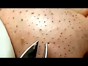 Blackhead Fields Naevus Comedonicus