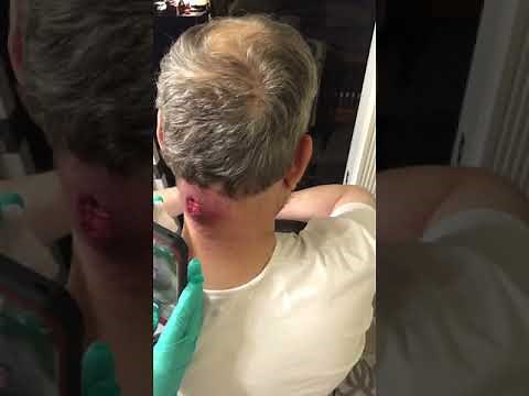 Carbuncles/ changing Ted’s dressing