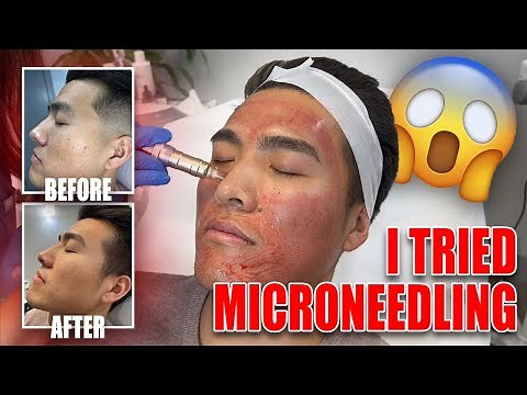Before and After 3 Microneedling Sessions!