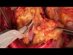 Video 1: Neck dissection for oral cancer-full step by step guide full