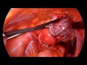 Dermoid Cyst of Ovary - Laparoscopic Removal Without Spillage