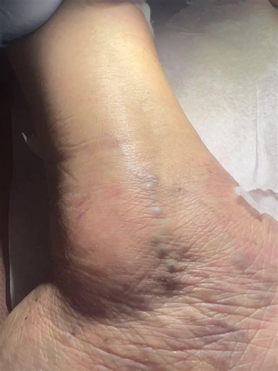 Sclerotherapy treatment on ankle varicose vein #theveindoctor #spiderveins #asmrvideo #phlebology #varicosevein #varicoseveintreatment #mexico #tijuana