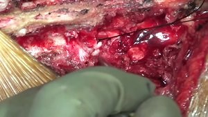 TLIF (Transforaminal Lumbar Interbody Fusion) - Surgical Steps for L4/5 Canal Stenosis With Instability