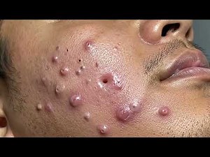 Blackhead Extraction Using Tools | Professional Technique Guide