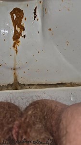 Gassy lactose intolerant diarrhea