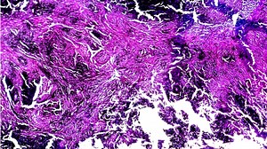 Silicosis lung with black deposit human pathology biosample under microscopy  | Respiratory Therapy Zone | Facebook