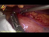 Lap Removal of Foreign Body Punctured the Stomach Wall • Video • MEDtube.net