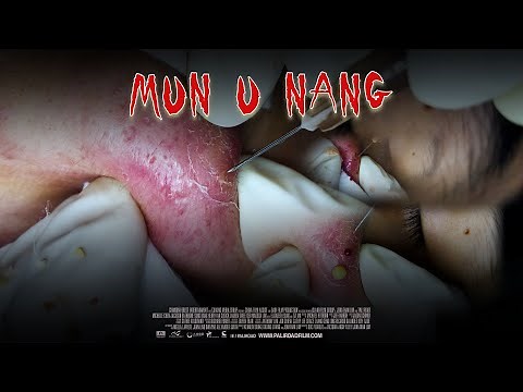 [Special] Big Cystic Acne Blackheads Extraction Blackheads & Milia, Whiteheads Removal Pimple Poppin