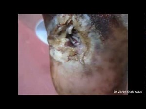 Maggots Inside Wound
