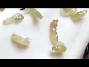Acne Extraction & Blackhead Removal Compilation | Hai Long Spa #042