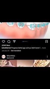 Orthodontic treatment facilities allow us to bring out the Impacted Canine into main occlusion which serve the patient , both cosmetic and functional purpose 👌🦷👍✌️🦷🦷🦷🦷. Happy Dentistry , guys ✌️🥰 | Radiant Smile Dental Clinic