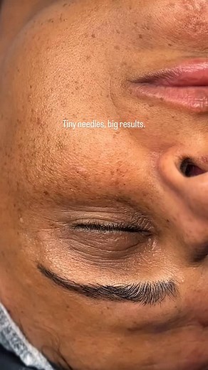 Transform your skin, one tiny needle at a time! ✨ #MicroneedlingMagic #colindale #dermapen #microneedling | Prestigious Aesthetics