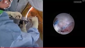Primary Labral Repair and Femoroplasty through a T-Capsulotomy with intraoperative Resection Planning and Execution Tool