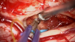 #186: Resection of an Intramedullary Spinal Arteriovenous Malformation with an Intranidal Aneurysm - Arteriovenous Malformation - Seven Series Collection