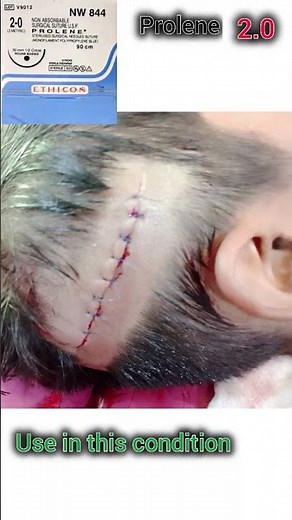 prolene 2.0 use