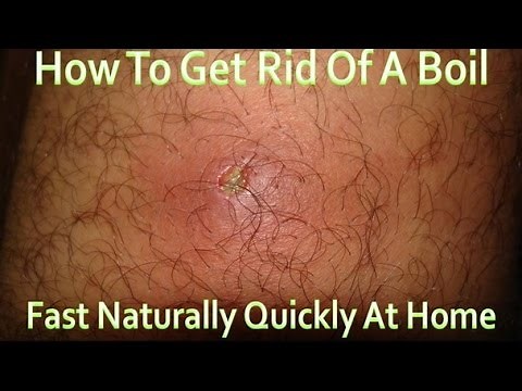 How To Get Rid Of A Boil Fast Naturally At Home