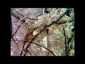 My Dandruff Flakes vs. 1000x’s Microscope