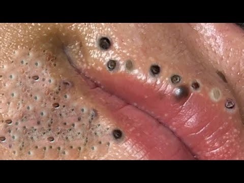 Big Cystic Acne Blackheads Extraction Blackheads & Milia, Whiteheads Removal Pimple Popping # 334