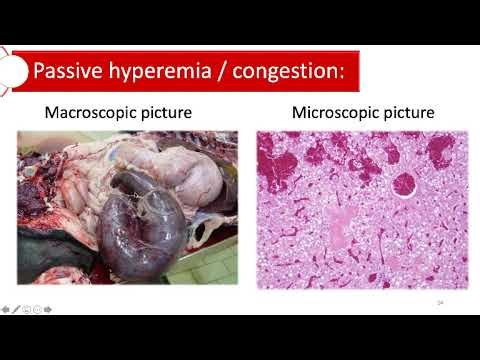 Hyperemia and congestion