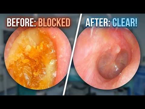EXTREME IMPACTED EAR WAX - Thick Keratin Plug Removal - EP1235