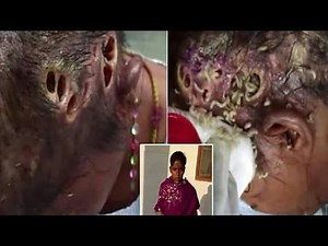 Homeless woman in India has head infected with maggots