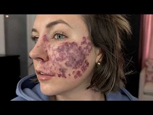 SURGERY VLOG ❤️‍🩹 my 11th laser surgery + before/after of my vascular birthmark