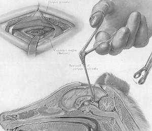 Pineal Region Tumor (Infratentorial Supracerebellar Approach) | Cohen Collection | Volumes | The Neurosurgical Atlas