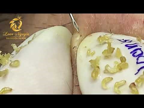ACNE TREATMENT AND BLACKHEADS REMOVAL (382) | Loan Nguyen