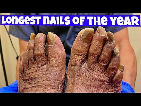 LONGEST TOENAILS DEBRIDEMENT OF THE YEAR