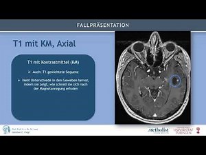 Astrozytom: Fallvorstellung und minimalinvasive Operation