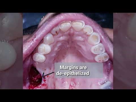 #OroAntralFistulaClosure (#OAF) #Rehrmann'sBuccalAdvancementFlap