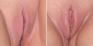 Clitoral erection - Alchetron, The Free Social Encyclopedia
