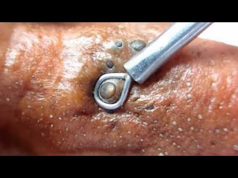 blackheads new 2021,😍 removal blackheads,✅ oddly satisfying