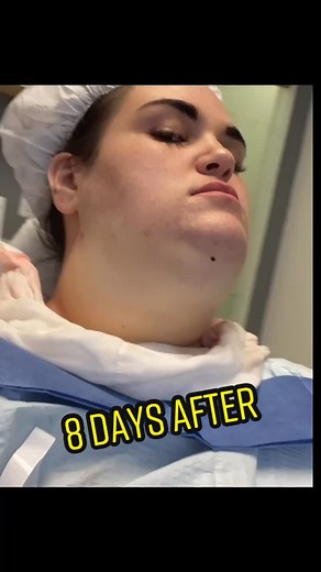 8 Days After Chin & Jaw Lipo with @cardeume #lipo #plasticsurgery #cardeume #doublechin #beforeandafter #lipopapada
