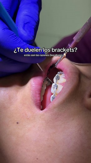 ¿Por qué duelen los brackets? Causas y cómo aliviarlo