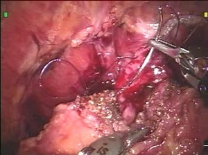 Robotic radical prostatectomy surgery