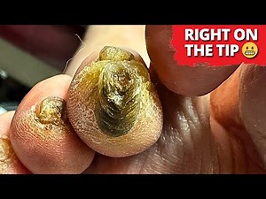 This Toe Corn Was WAY Deeper Than Expected 😳