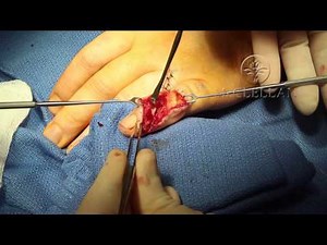 Live Surgery: Small Finger Extensor Tendon Saw Injury Cut Repair