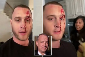 Tom Hanks' son Chet bleeds from head & claims ex 'attacked him with knife'