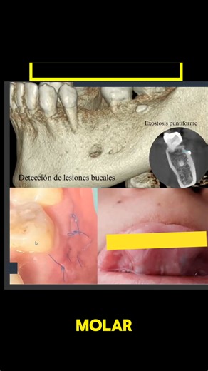 1.2K views | Caso clínico exostosis #shorts #exostosis #casoclinico #odontologia | Odontoblog | Facebook